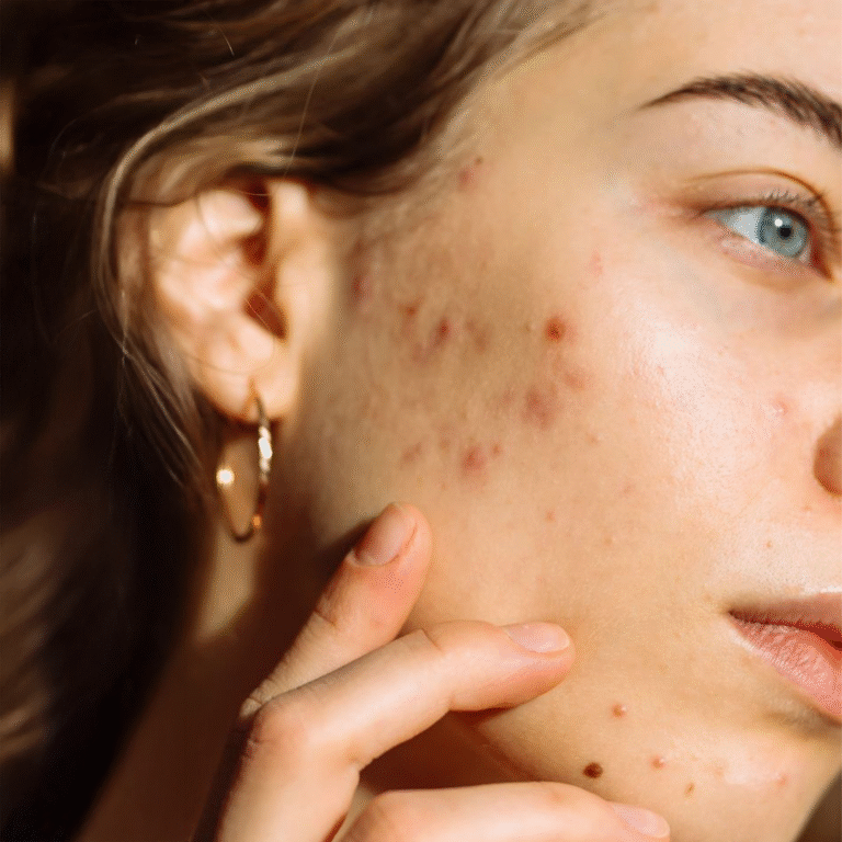 How to Get Rid of Acne Scars